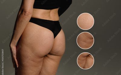 COMMENT ELIMINER LA CELLULITE ?