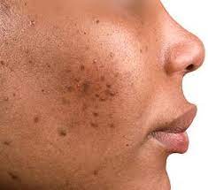 COMMENT ATTENUER LES TACHES D’HYPERPIGMENTATION SUR LES PEAUX NOIRES?